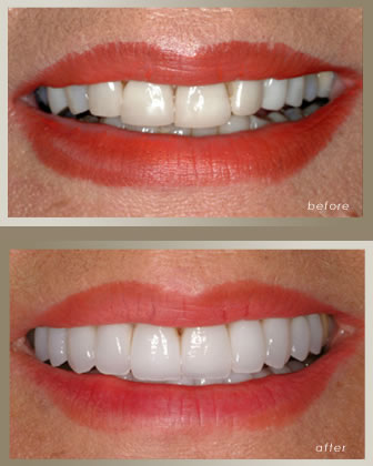 Smile Makeover 6